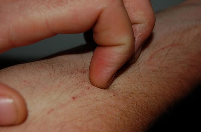 prurito cutaneo come sintomo della presenza di parassiti