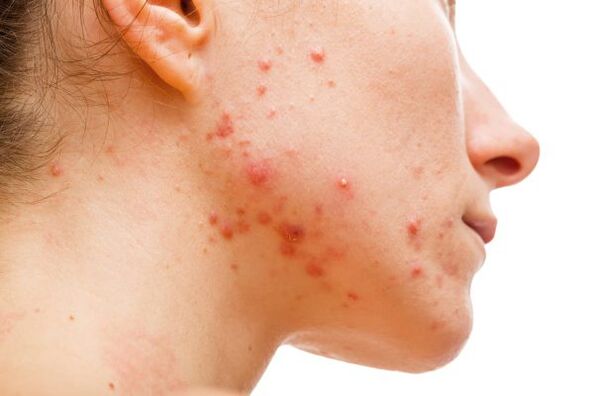 acne dovuta a parassiti sottocutanei