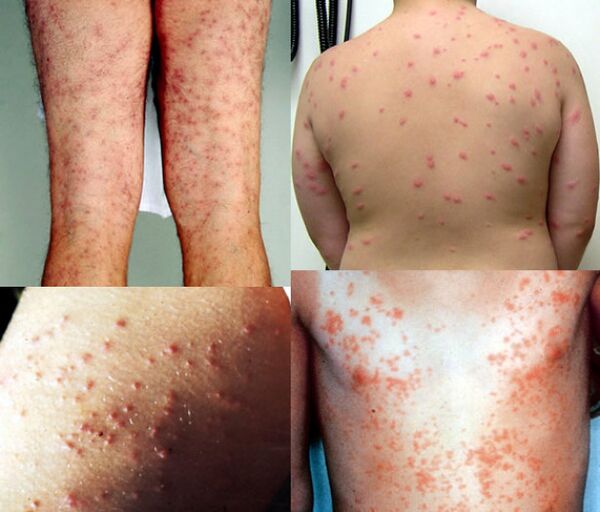 eruzioni cutanee su tutto il corpo a causa di parassiti