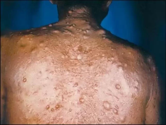 nodi purulenti sulla pelle a causa di parassiti