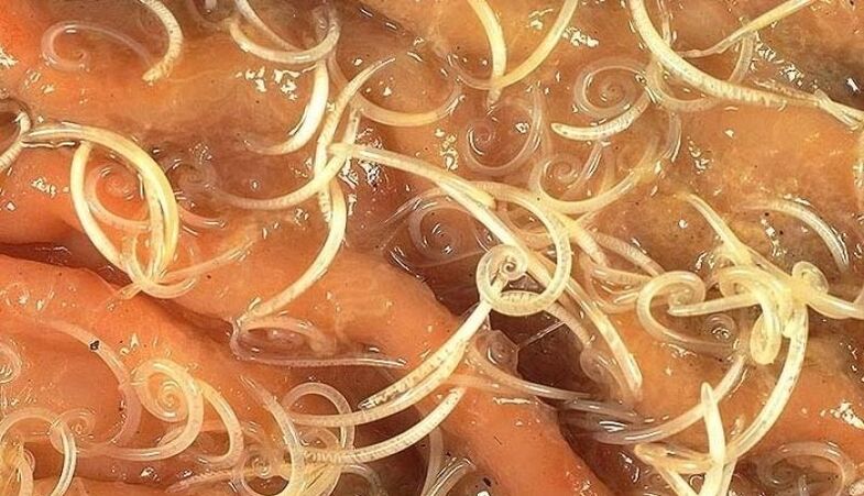 vermi dal corpo umano