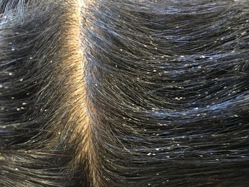 conseguenze degli acari sottocutanei