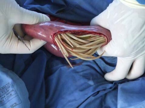 parassiti nell'intestino